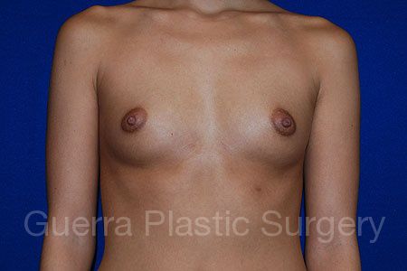 Case #27993 Before