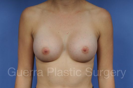 Case #1001167 After