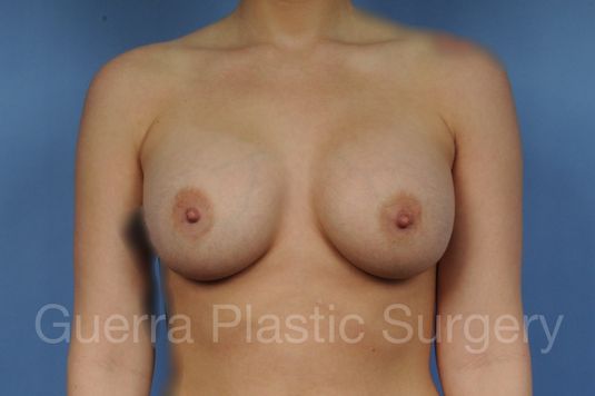 Case #1001172 After