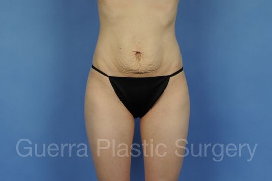 Case #15309 Before