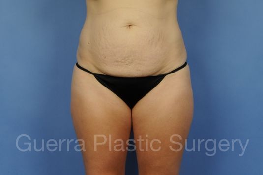 Case #01305 Before