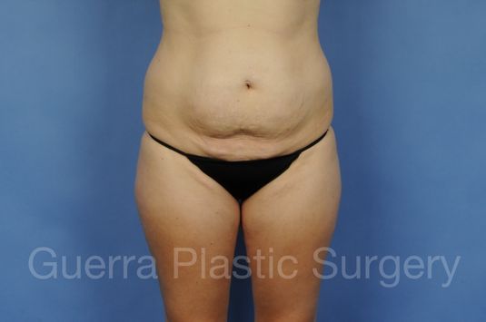 Case #01306 Before