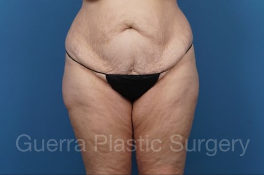 Before Photo Tummy Tuck