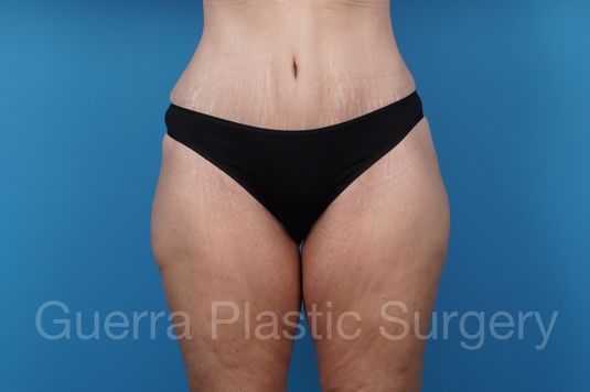 After Photo Tummy Tuck