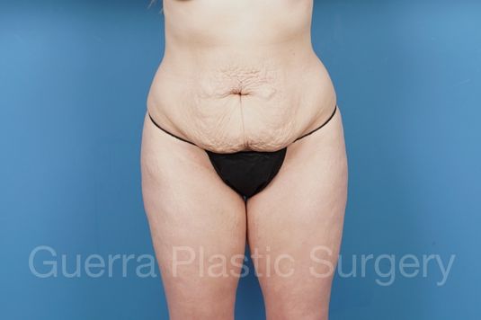 Case #36140 Before