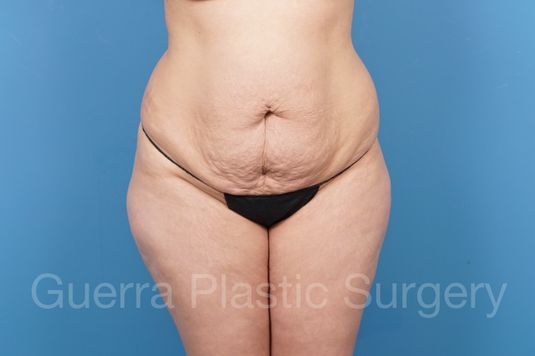 Case #35814 Before
