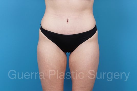 prev Case #36742 After