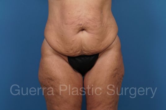 next Case #36370 Before