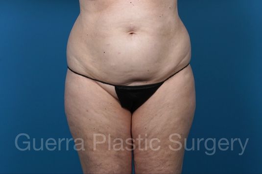 Before Photo Tummy Tuck