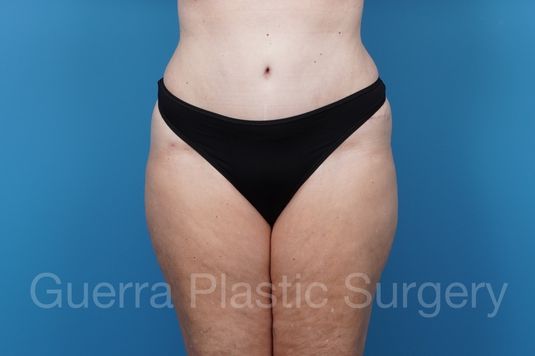After Photo Tummy Tuck