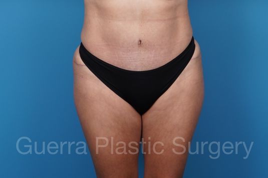 prev Case #36595 After