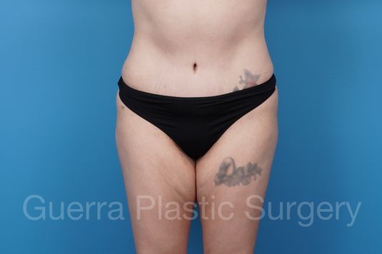 prev Case #36894 After