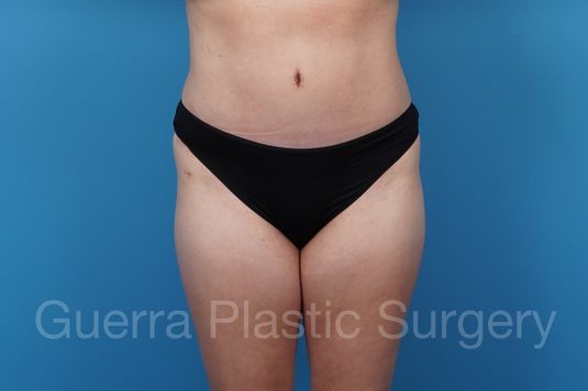 prev Case #37066 After