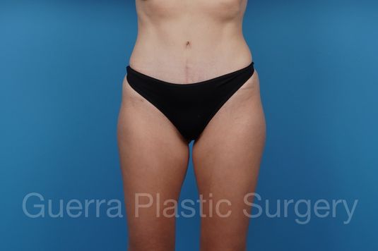 prev Case #37261 After