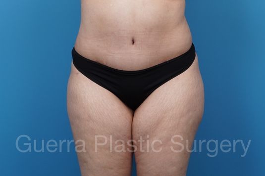 prev Case #37007 After