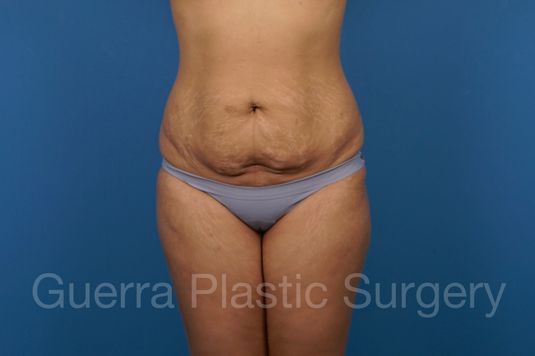 prev Case #36082 Before