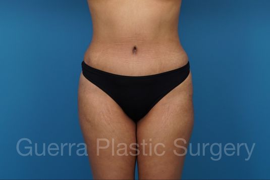 prev Case #36082 After