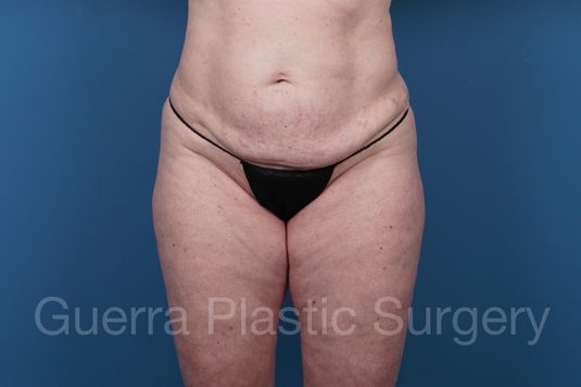 next Case #35570 Before