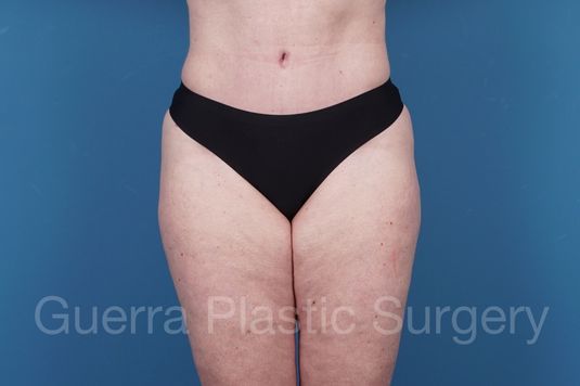 next Case #35570 After