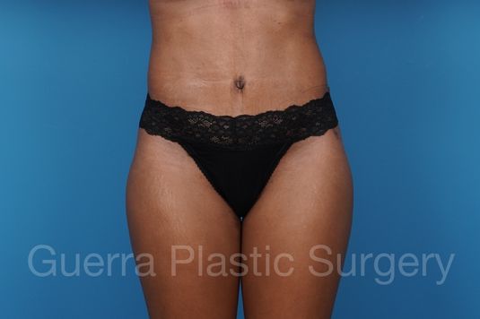 prev Case #40413 After