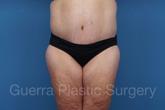 next Case #28745 After