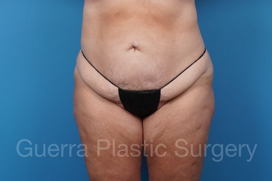 Before Photo Tummy Tuck