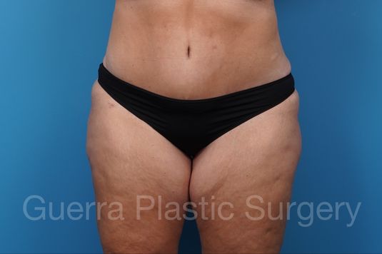 After Photo Tummy Tuck