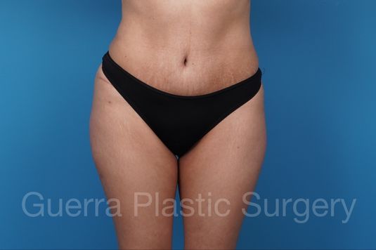 prev Case #37710 After