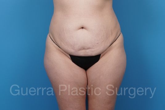 Before Photo Tummy Tuck