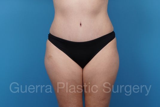 After Photo Tummy Tuck