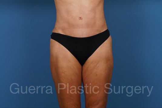 prev Case #34686 After