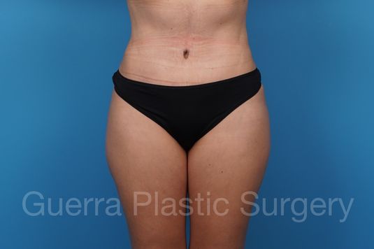 prev Case #37401 After