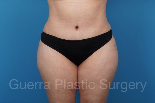 next Case #39172 After