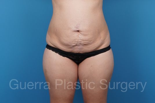next Case #39785 Before