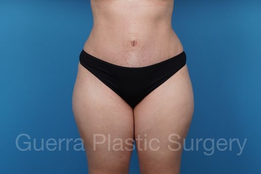 next Case #39785 After