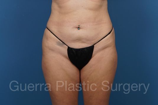 next Case #36837 Before