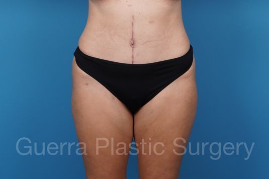 next Case #36837 After
