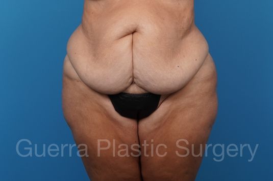 Before Photo Tummy Tuck