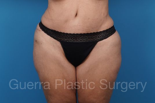 After Photo Tummy Tuck