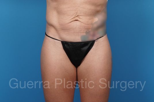 prev Case #38146 Before