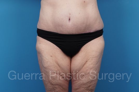 prev Case #40155 After