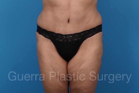 prev Case #40613 After