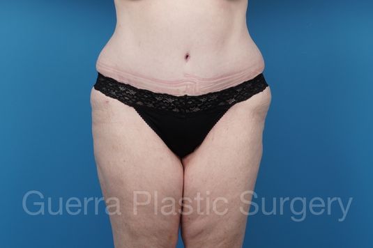prev Case #39454 After