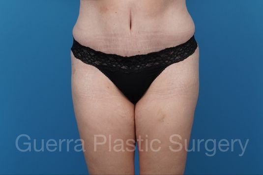 prev Case #35595 After