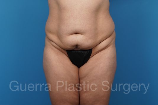 prev Case #41161_2 Before