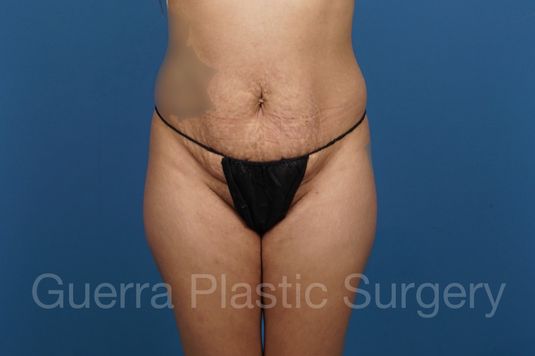 Before Photo Tummy Tuck