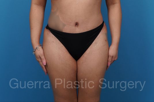 After Photo Tummy Tuck