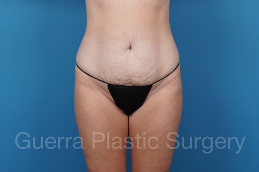 Case #43076 Before