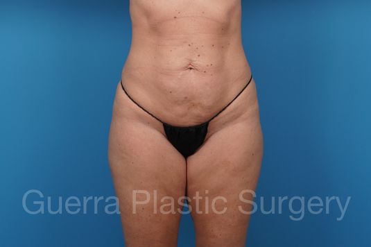 Before Photo Tummy Tuck