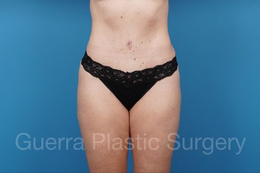 After Photo Tummy Tuck